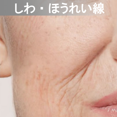 Eライト対応メニュー　しわ・ほうれい線