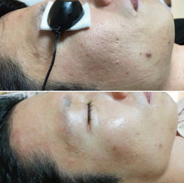 カーボンピーリング1回施術