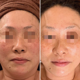 Eライトでのシミケア1回施術