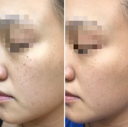 Eライトでのシミケア1回施術