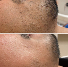 ヒゲ脱毛8回施術