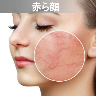 Eライト対応メニュー　赤ら顔