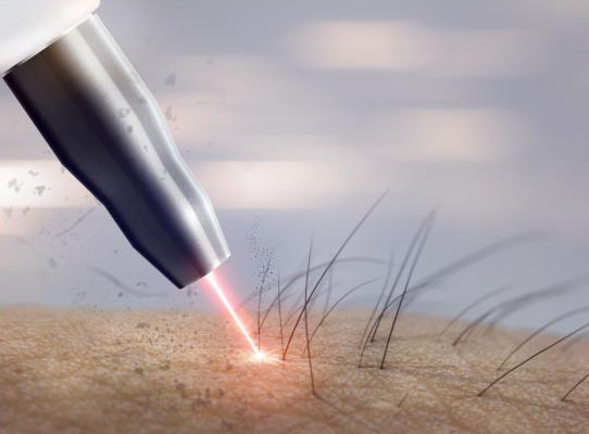 レーザー脱毛の写真