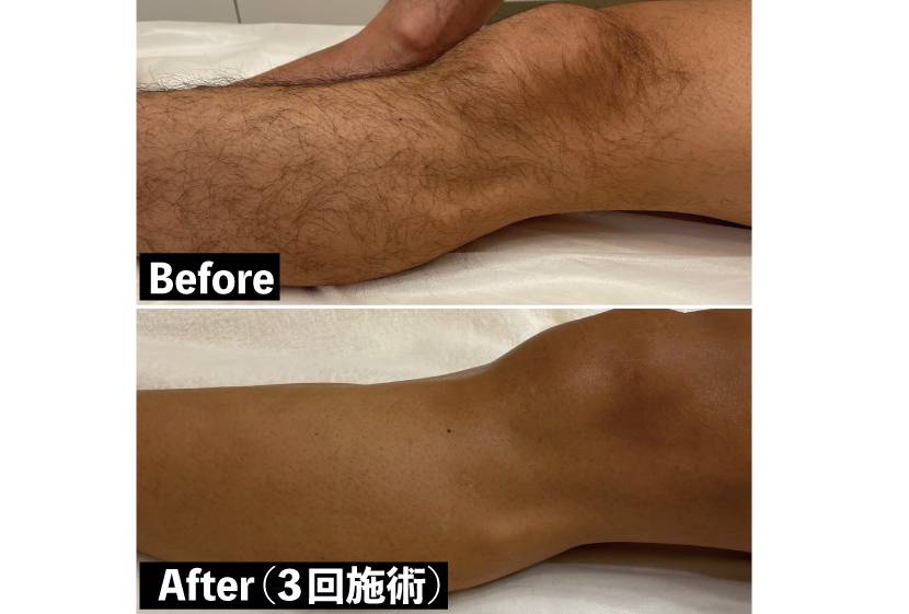 ペガサスプロの日焼け肌ビフォアアフター