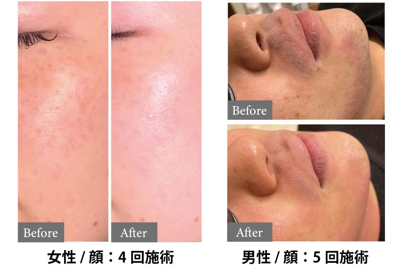 ニキビ跡-ビフォーアフター