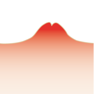 ニキビ跡-赤ニキビ