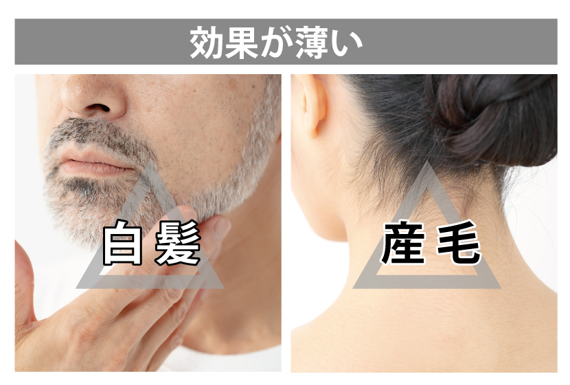 IPLは白髪と産毛に効果が薄い