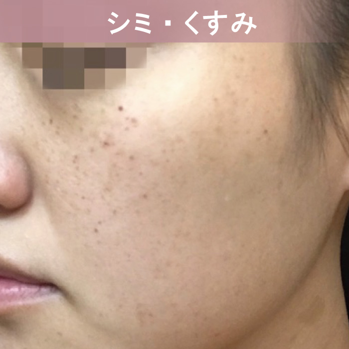 ピクシーツインのフェイシャル機能-シミ・くすみの改善