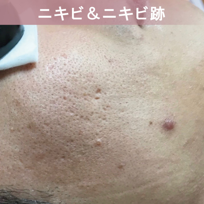 ピクシーツインのフェイシャル機能-毛ニキビ＆ニキビ跡の改善