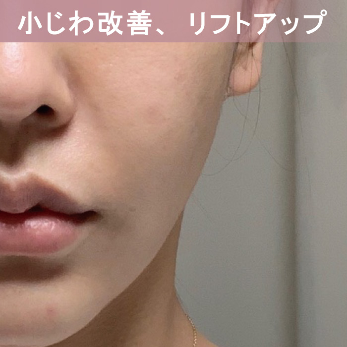 ピクシーツインのフェイシャル機能-小じわ改善、リフトアップ効果