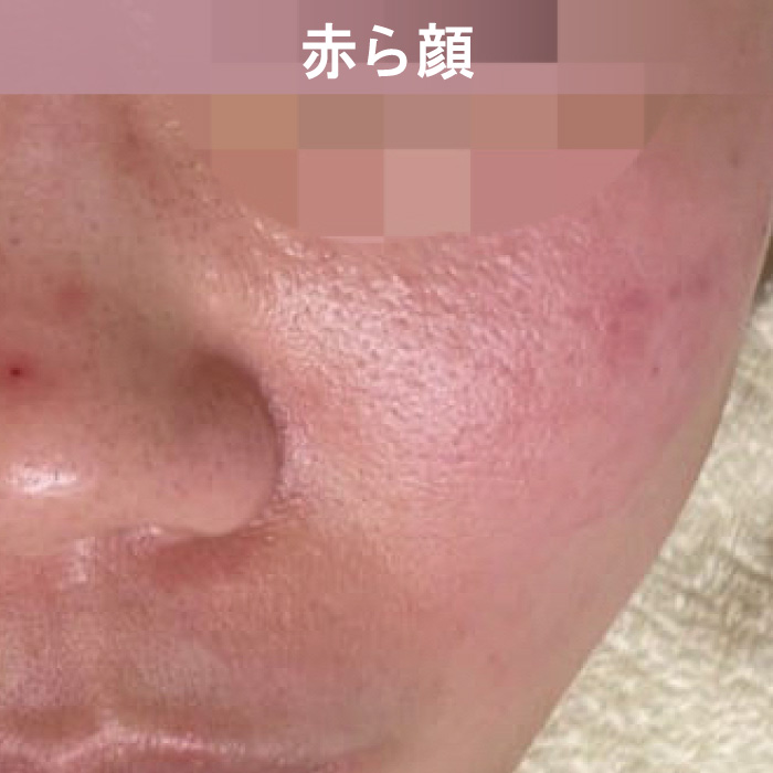 ピクシーツインのフェイシャル機能-赤ら顔の改善